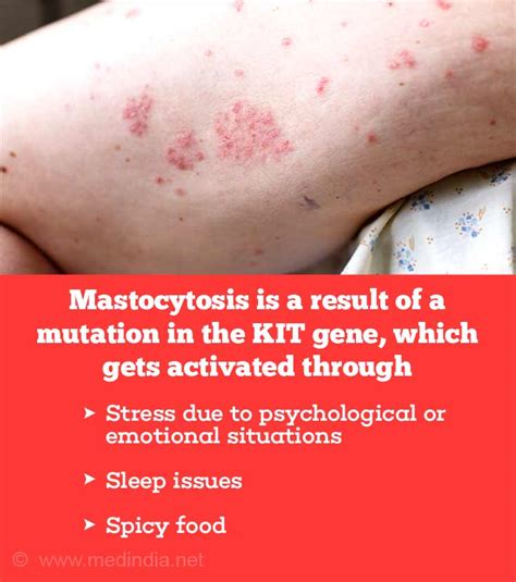 indolent systemic mastocytosis